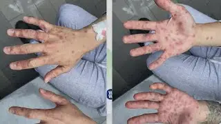 Number of monkeypox cases reported in Texas grows to 20
