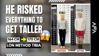 CHINA PATIENT’S LIMB LENGTHENING JOURNEY | +6 CM TALLER