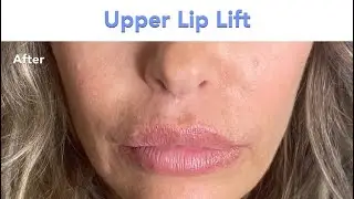 Lip Lift 101: Everything You Need to Know | Dr. Michael Mirmanesh | The Garden Medical Spa