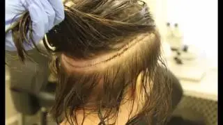 BHR Clinic, Dr. Bisanga. 3275 FUT - Transgender patient. 0-15 Months