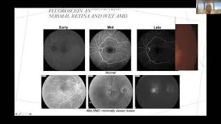 Neovascular AMD I have Options  Help!