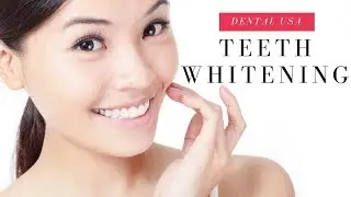 Lumibrite teeth whitening