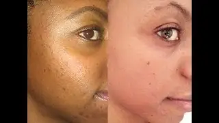 Homemade acne treatment || HIGHLY REQUESTED