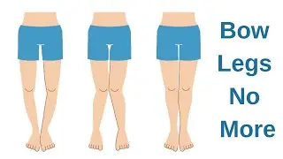 Bow legs no more - 100% natural way to straighten your legs