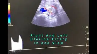 Right and left uterine artery in single view in 20 weeks pregnancy