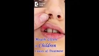 Mouth Ulcers in Children  Causes & Treatment - Dr. K Saranya |Doctors' Circle #shorts