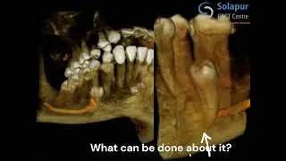 Could This Jaw Pain Have Been Prevented?|Anomaly Scan Explained|Jaw Nerve Compressed by Hooked Root?