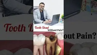 Can a Tooth Die Without Pain &ndash; Painless Infection Explained!