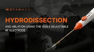 Hydrodissection and Ablation Using the VIVA II Adjustable RF Electrode
