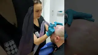 Adio Chelie Micropigmentare Scalp