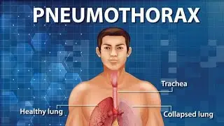 Pneumothorax Made Easy | Causes, Symptoms, Diagnosis & Nursing Management | Med-Surg Nursing---
