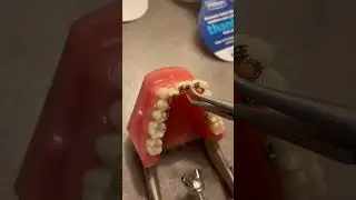 InBrace wire removal