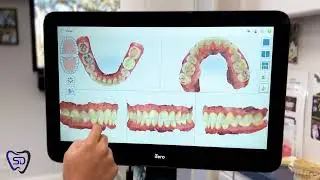 How the iTero Health Scan Benefits Our Patients