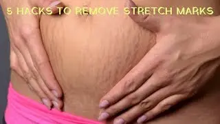 5 Hacks to Remove Stretch Marks - Easy Ways to Remove Stretch Marks