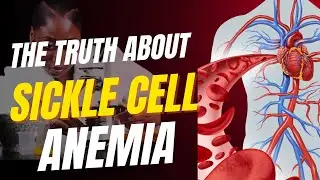 Sickle Cell Anemia | Dehydration | Severe Pain | Flare ups | Treatments | Nurse Shay Gill