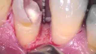 Crown lengthening