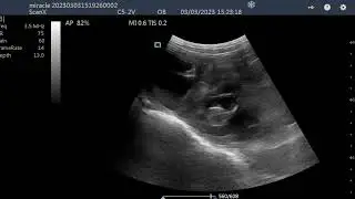Miracle goat Ultrasound 75 days