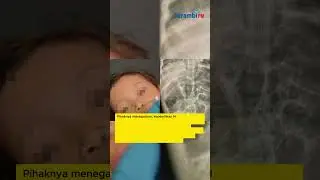 Kasus Balita Sukabumi Cacingan Tak Tercatat sebagai Peserta JKN, Ini Respons BPJS Kesehatan