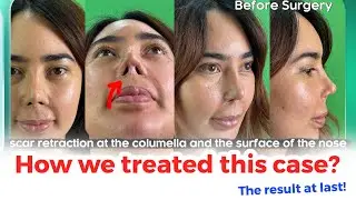 Failed Nose Job Fixed Her Inspiring Revision Rhinoplasty Journey at Saigon Venus