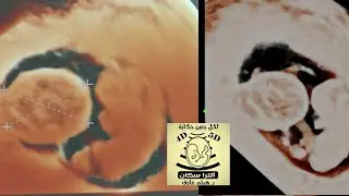 chorionic bump obstetric ultrasound