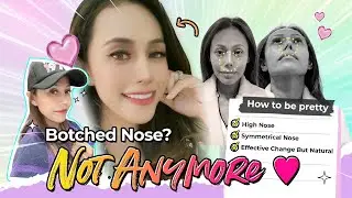 [Plastic Surgery Korea] Botched Nose? Not Anymore With Revision Rhinoplasty! (Feat. Lana)