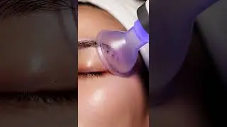 Inner Eyebrow Blackhead Removal ASMR #macroasmr #skincare #asmr #asmrskincare #satisfying