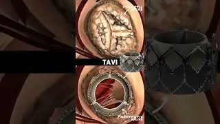 Transcatheter Aortic Valve Implantation (Artificial Heart Valve) #shorts #cardiology #hearthealth