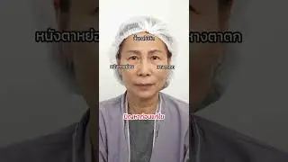 รีวิว Subbrow Lifting 7 วัน สวยเป๊ะเว่อร์ #Subbrowlift #หมอไอยู #รีวิวตาสองชั้น #ยองโดคลินิก