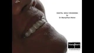 DIGITAL SMILE DESIGNING by Dr Abarajithan Mohan @ Mohan's Micro Dentistry