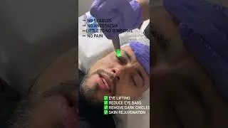 Get Rid of Under Eye Bags and Dark Circles | Fotona Eye Laser for Men | SmoothEye