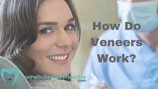 How do Veneers Work?