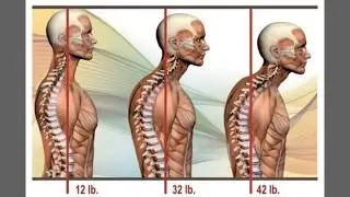 Chiropractor Austin TX | What is Dowager's Hump?
