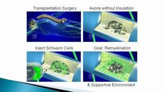 Safety Trial of Schwann Cell Transplantation in Subacute Spinal Cord Injury Completed Successfully