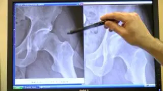 A-Rod, Gaga Among Young Diagnosed With Jagged Hip Joints | Video