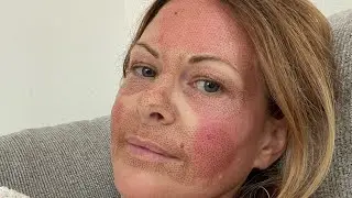 Lindsay&rsquo;s Fibroblast Plasma treatment and the healing process
