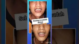 10 bulan dibehel pd gigi tonggos 9 mm