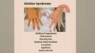 Stickler Syndrome