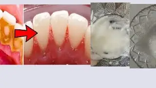 NATURAL WAY TO REMOVE TEETH PLAGUE | HEALTHYTIPS | DIY