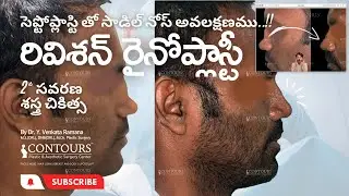 రివిశన్ రైనోప్లాస్టీ | సాడిల్ నోస్| REVISION RHINOPLASTY | SADDLE NOSE DEFORMITY | in TELUGU