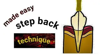 Master the Step-Back Technique in Endodontics: The Definitive Root Canal Preparation Guide 