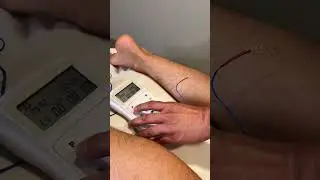 ⚡ELECTRICAL ACUPUNCTURE⚡