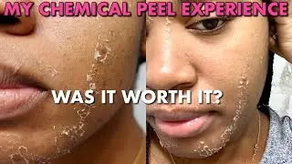 CHEMICAL PEEL RESULTS ON BLACK SKIN | HOW TO GET RID OF HYPERPIGMENTATION| GOLDENCHILDCHI