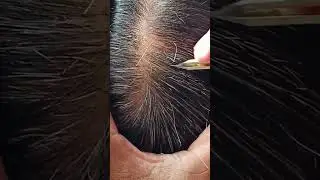 Most satisfying white hair removal 0.28#satisfying #hairremoval #musicbackground