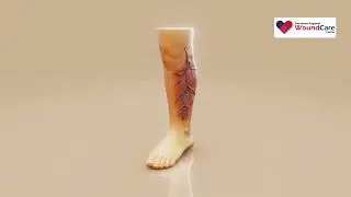 Bulging Leg Veins in Lubbock, TX: When to Seek Expert Care