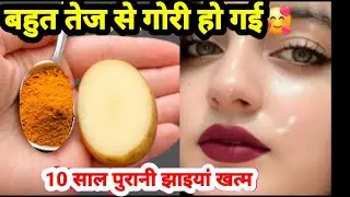आलू से झाइयां हटाने का कमाल का तरीका | Reduce Melasma, Pigmentation, Discolouration, Blackspots