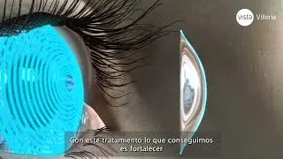 ¿Cómo es el tratamiento del Queratocono? Crosslinking para Queratocono