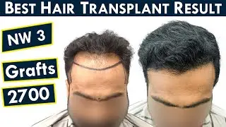 Grade 3 Baldness Results - 2700 Grafts || Best Hair Transplant Result Ahmedabad || HFHG Clinic
