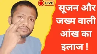 Eye swelling and pain treatment | आँख में जलन और सूजन का इलाज?