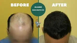 Dr.Zarev - 10683 grafts FUE in 2 chirurgie