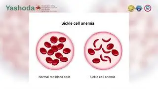 Dr. (Col.) Tarun Verma | Spreading awareness on Blood Cancer and role of BMT | Yashoda Healthcare